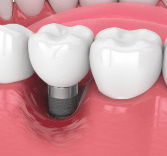 Impianti dentali e infiammazione: la perimplantite